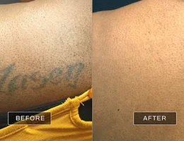 Removery Tattoo Removal & Fading