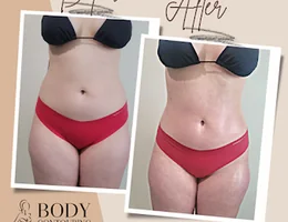 Body Contouring Beauties