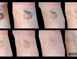 Removery Tattoo Removal & Fading