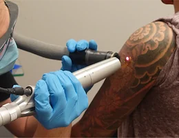 Removery Tattoo Removal & Fading